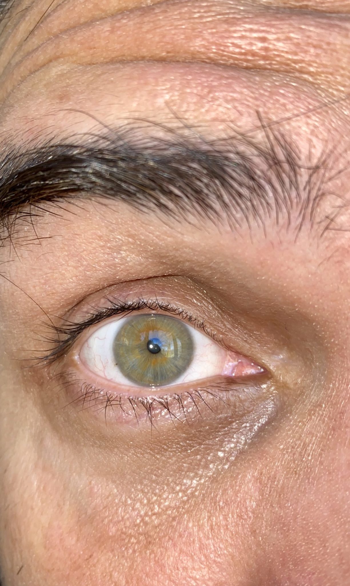 Unknown Prism Eye Institute