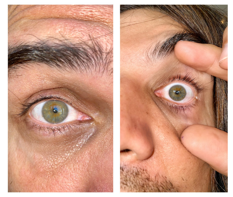 Eye Picture Instructions Prism Eye Institute